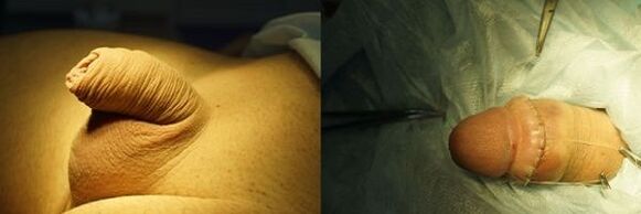 varpos prieš ir po padidinimo operacijos