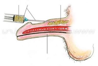 injekcijos varpos padidinimas